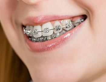 Best Dental Hospitals in Guntur,Best Dental Hospital in Guntur,Best Dental Doctor in Guntur,Best Dental Doctors in Guntur,Best Dental Clinic in Guntur,Best Dental Clinics in Guntur,Famous Dental Hospitla in guntur,Famous dental hospitals in guntur,Best Dental clinic near me,Best Evening Hospitals in Guntur,Best Orthodontist in guntur,Braces Treatment in Guntur,Best Dentist in Guntur,Best Dentists in Guntur,Best Habit breaking appliance treatment in Guntur,Hygienic dental Hospital in Guntur,Hygienic dental Hospitals in Guntur,Top Dentist in guntur,Top Dentistits in guntur,Top Dental Clinics in Guntur,Top Oarl Dental Clinics in Guntur,Top Dental Clinic in Guntur,Best Dental Implants in guntur,Top Dental Doctors in guntur,Top Dental Doctors in Guntur,Oral treatments and dental health services in Guntur,Oral treatments and dental health services in Guntur,Dental Braces in Guntur,Complete Dental Oral care in guntur,Best dental treatment in guntur,Best Fever Hospital in Guntur,Best Hypertensive Clinics in Guntur,Best thyroid doctors in guntur,Best Cardiologist in guntur,Best Evening clinics in Guntur