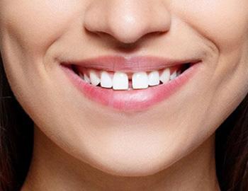 Best Dental Hospitals in Guntur,Best Dental Hospital in Guntur,Best Dental Doctor in Guntur,Best Dental Doctors in Guntur,Best Dental Clinic in Guntur,Best Dental Clinics in Guntur,Famous Dental Hospitla in guntur,Famous dental hospitals in guntur,Best Dental clinic near me,Best Evening Hospitals in Guntur,Best Orthodontist in guntur,Braces Treatment in Guntur,Best Dentist in Guntur,Best Dentists in Guntur,Best Habit breaking appliance treatment in Guntur,Hygienic dental Hospital in Guntur,Hygienic dental Hospitals in Guntur,Top Dentist in guntur,Top Dentistits in guntur,Top Dental Clinics in Guntur,Top Oarl Dental Clinics in Guntur,Top Dental Clinic in Guntur,Best Dental Implants in guntur,Top Dental Doctors in guntur,Top Dental Doctors in Guntur,Oral treatments and dental health services in Guntur,Oral treatments and dental health services in Guntur,Dental Braces in Guntur,Complete Dental Oral care in guntur,Best dental treatment in guntur,Best Fever Hospital in Guntur,Best Hypertensive Clinics in Guntur,Best thyroid doctors in guntur,Best Cardiologist in guntur,Best Evening clinics in Guntur